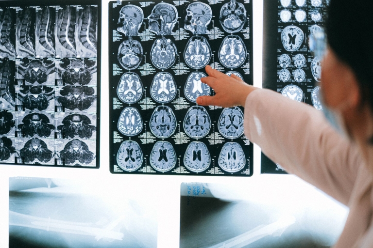 Alzheimer Hastalığında Beyin Ritimleri Zayıflıyor
